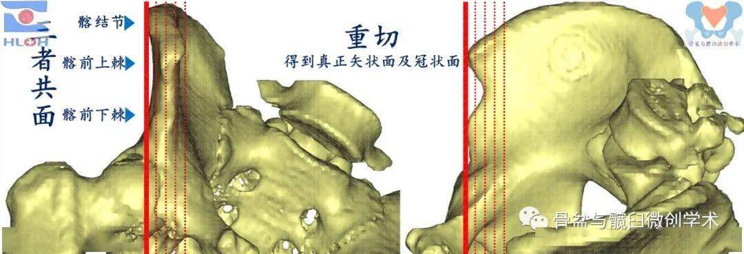 医工结合为创新仁心匠心乃本心保留髂嵴的半自动化髂骨翼取骨器械的