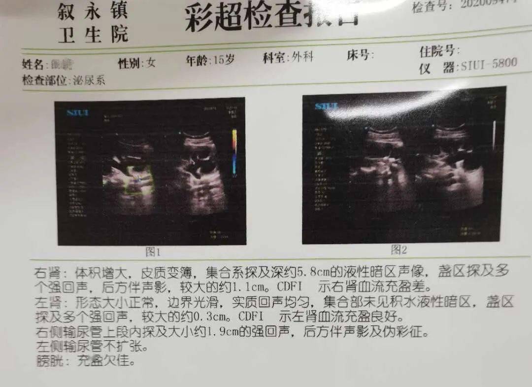 15歲輸尿管結石伴重度腎積水對的你沒看錯