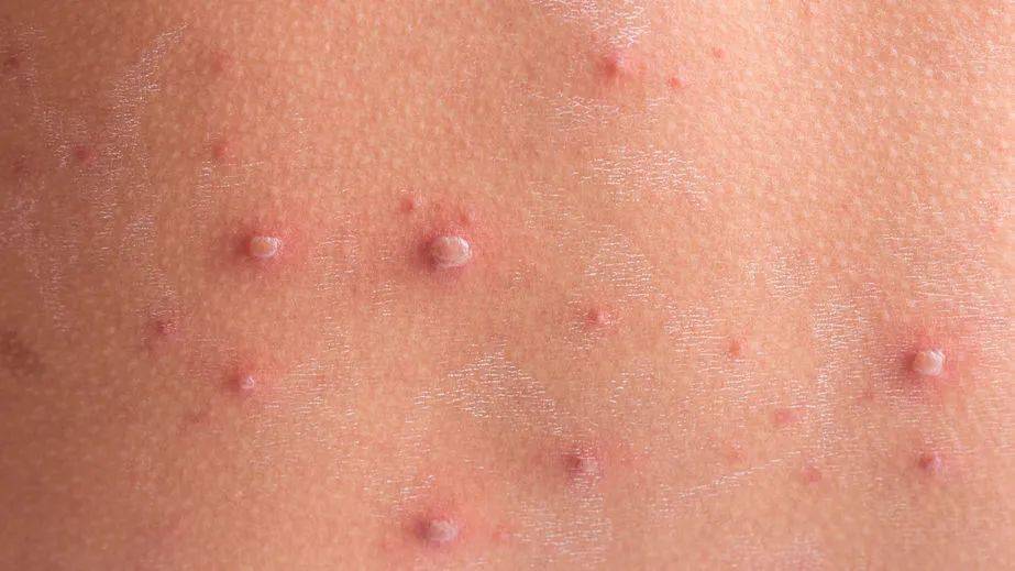 水痘传染性强,大人孩子都可发病!起水痘怕感染,到底能不能洗澡?