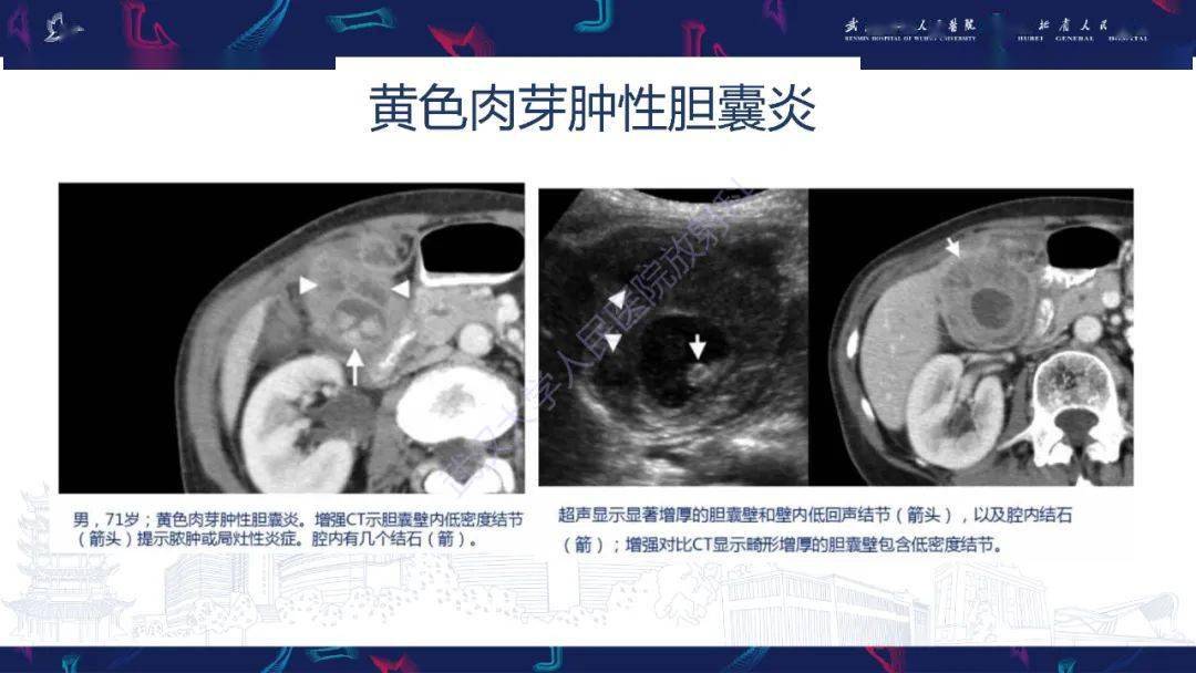 胆囊壁增厚影像鉴别诊断