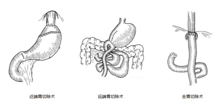 【医声医事】听市一院李新宇主任讲胃贲门早癌的手术经