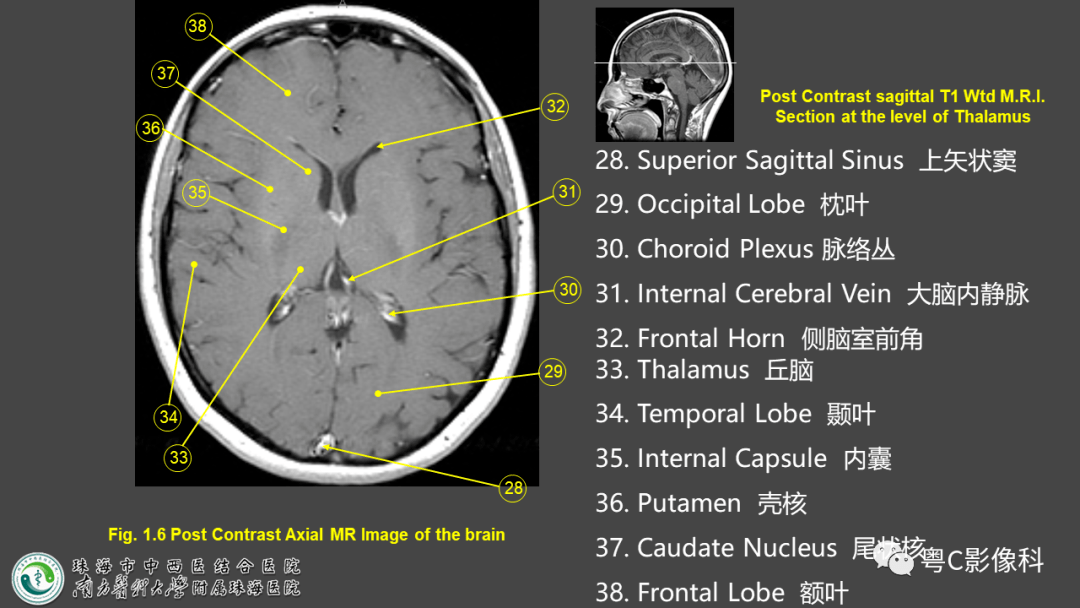 头颅磁共振解剖图图片