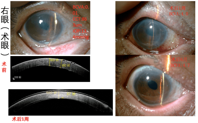 眼角膜水肿图片