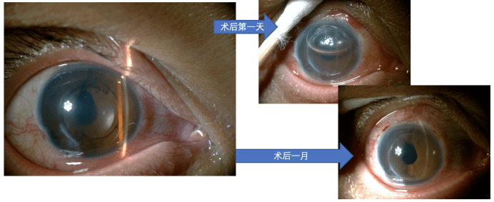 王林农教授白内障术后角膜水肿如何分析如何处理