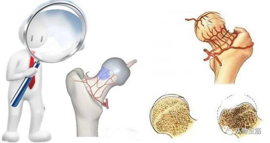 股骨頸骨折癒合了為什麼還出現股骨頭壞死