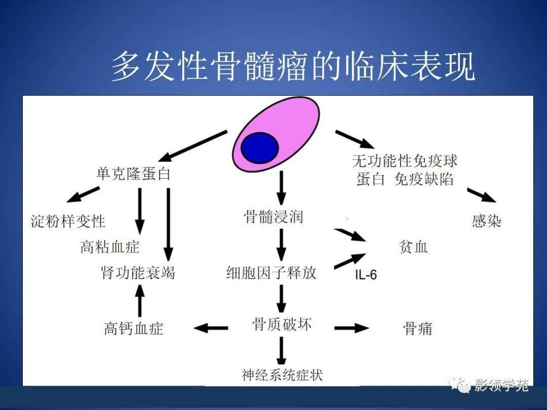 多发性骨髓瘤影像表现