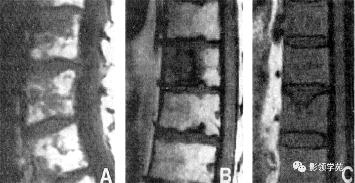 淀粉样变性和雷诺现象出血倾向高粘滞综合征肾功能损害感染血浆蛋白