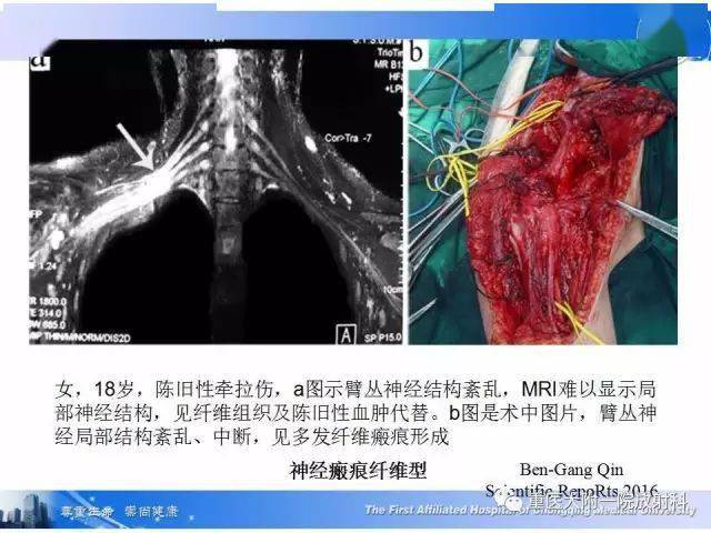 臂丛神经病变的影像学诊断