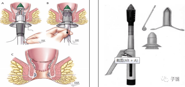 直肠手术吻合器示意图图片