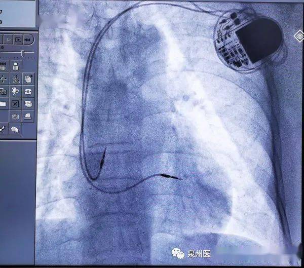 技术分享人民医院成功实施首例双腔心脏起搏器植入术