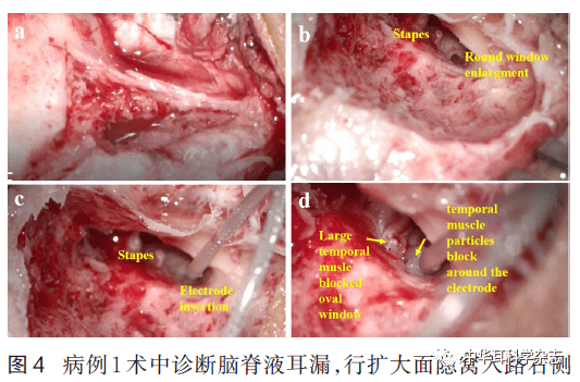 儿童脑脊液耳漏修补与人工耳蜗植入同期手术的探讨