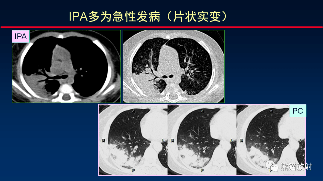 柳澄讲坛丨关于肺隐球菌病ct诊断的思考