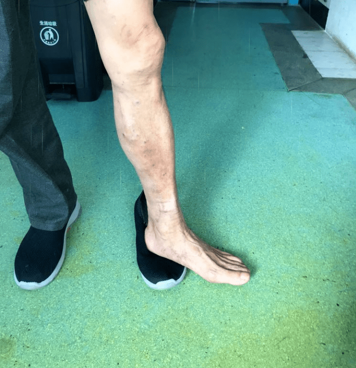 一开始腿部酸胀瘙痒 到后来慢慢开始 出现了"小蚯蚓"样的血管凸起