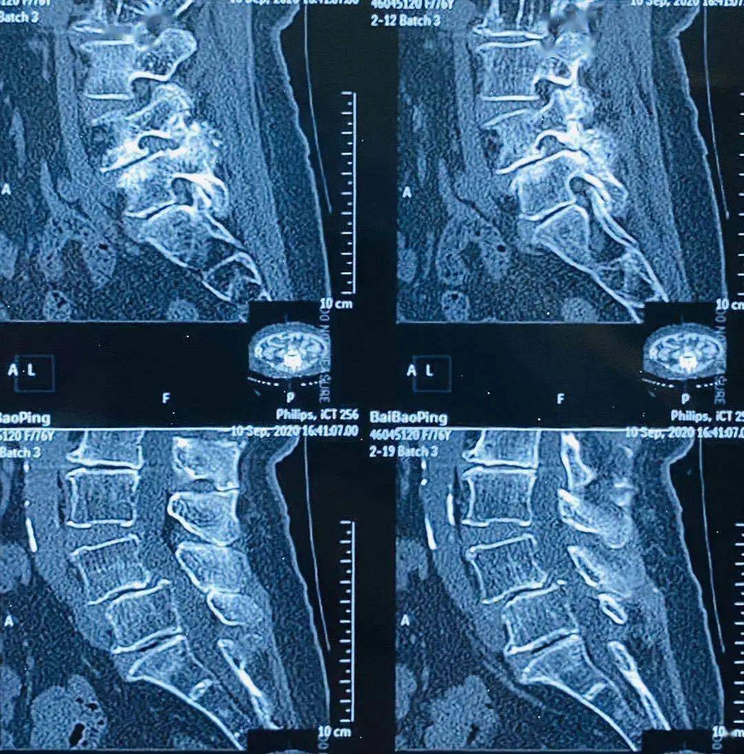 腰脱 片子图片