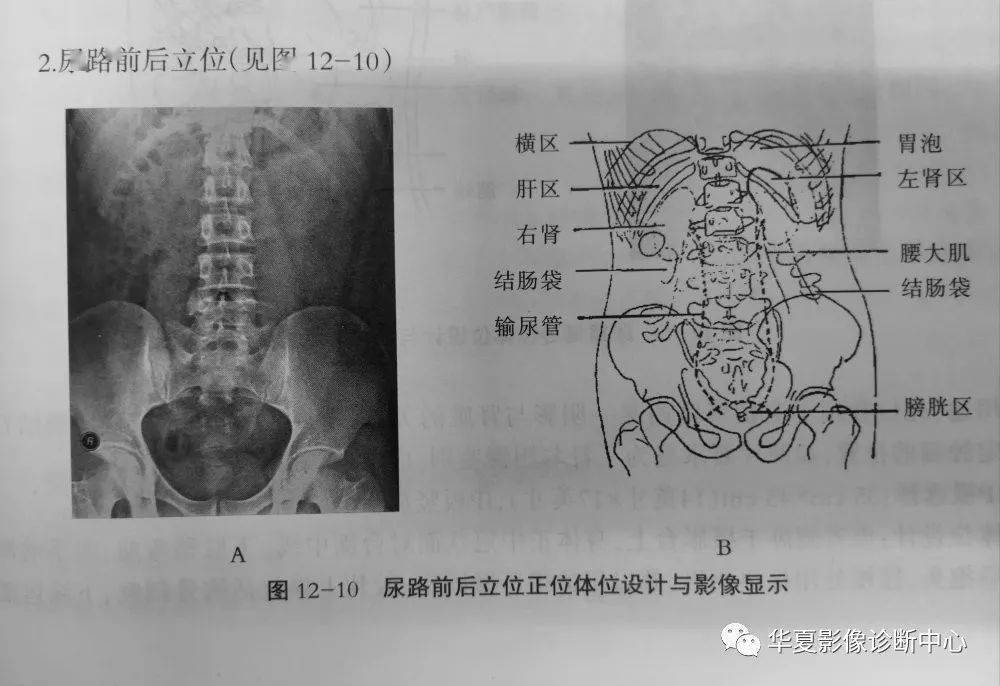 照片显示:双侧肾,输尿管及膀胱的影像,显示尿路结石位置,大小等情况.
