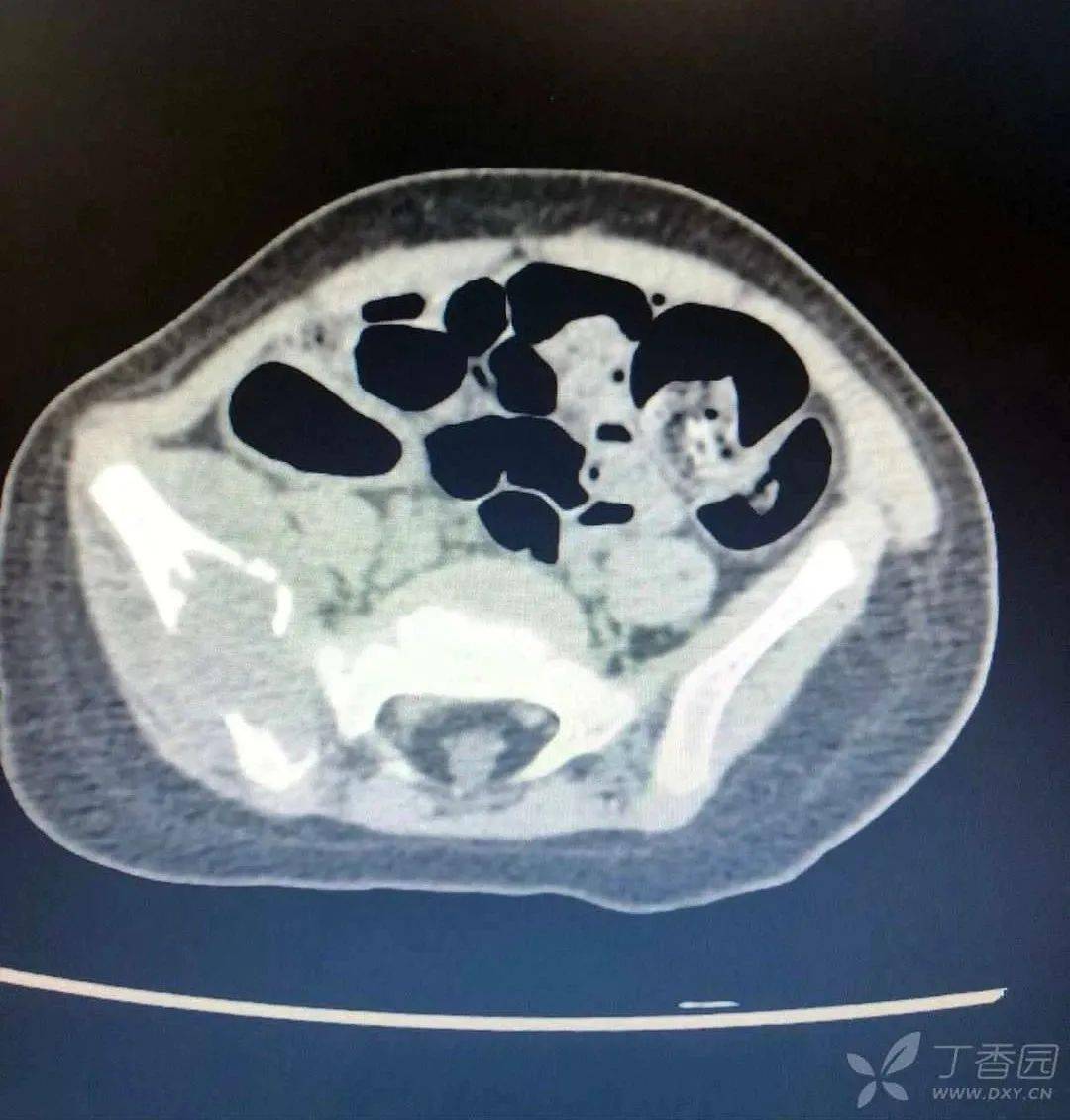 虫蚀样骨质破坏图片图片