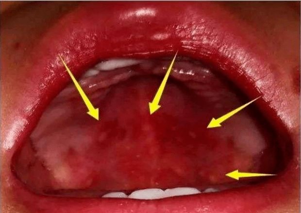 表现为咽部充血,起病2日内口腔黏膜出现数个(少则1～2个,多达10余个)