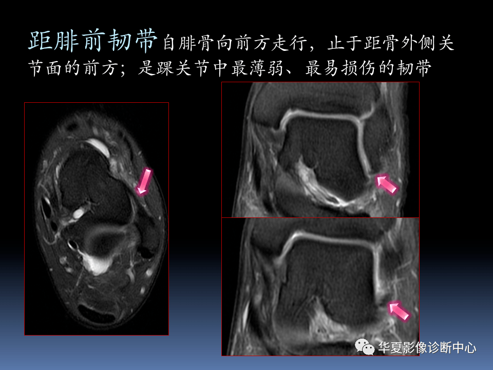 踝關節mri解剖與常見病變