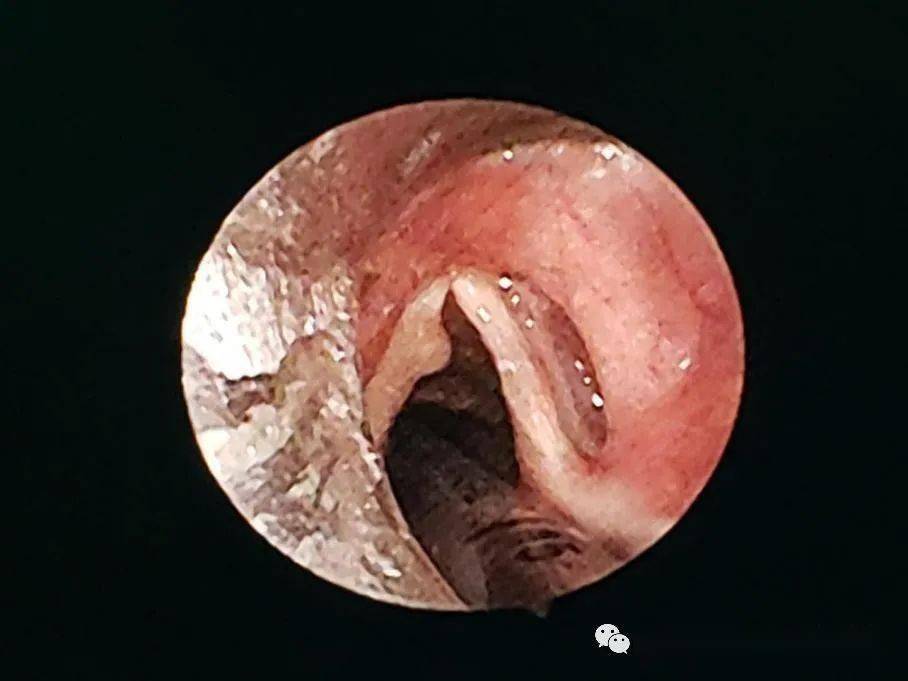 声带型鳞状细胞癌的微创手术舌体肥厚的消融手术口腔医院耳鼻喉科竭诚