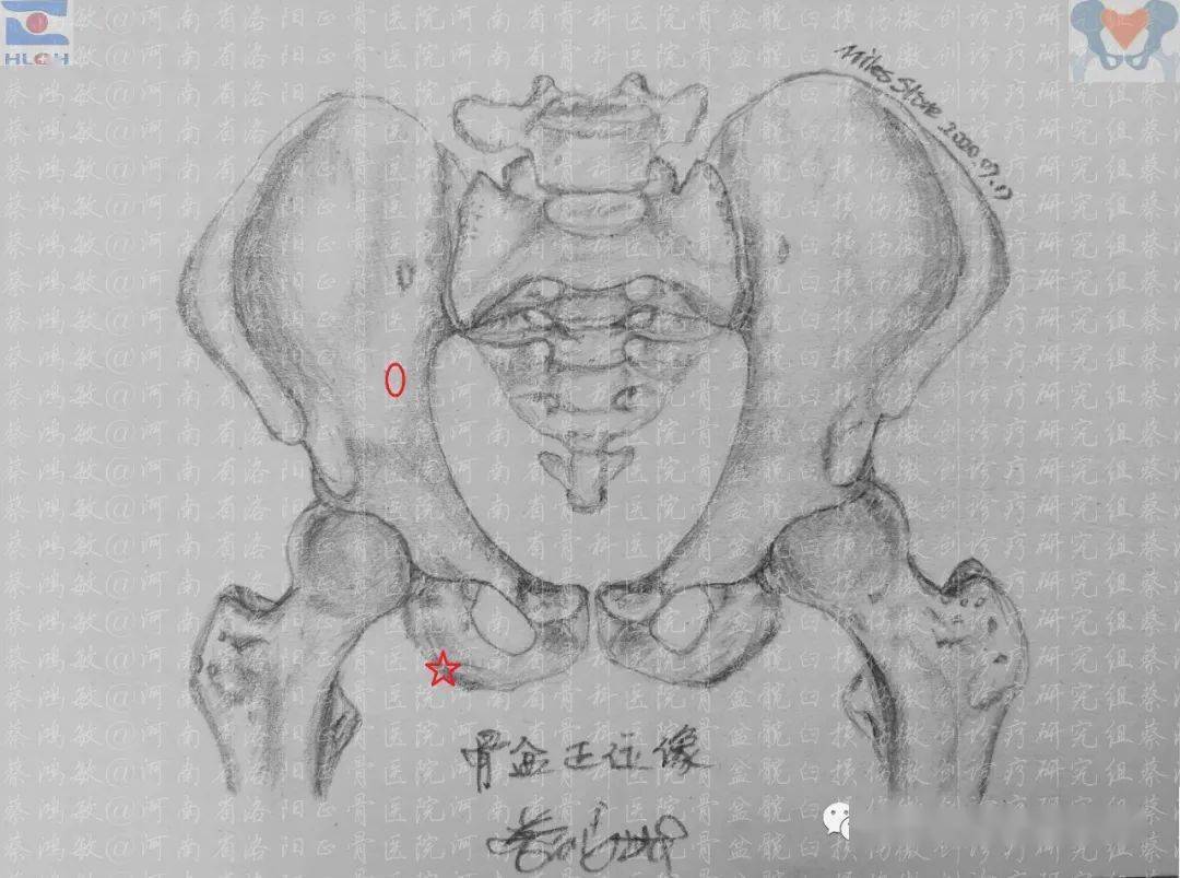 手绘经皮逆行髋臼后柱螺钉置入技术