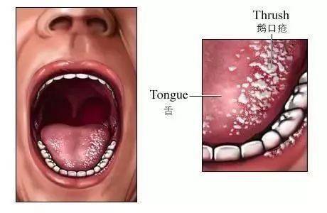 口腔黏膜丘疹图片图片