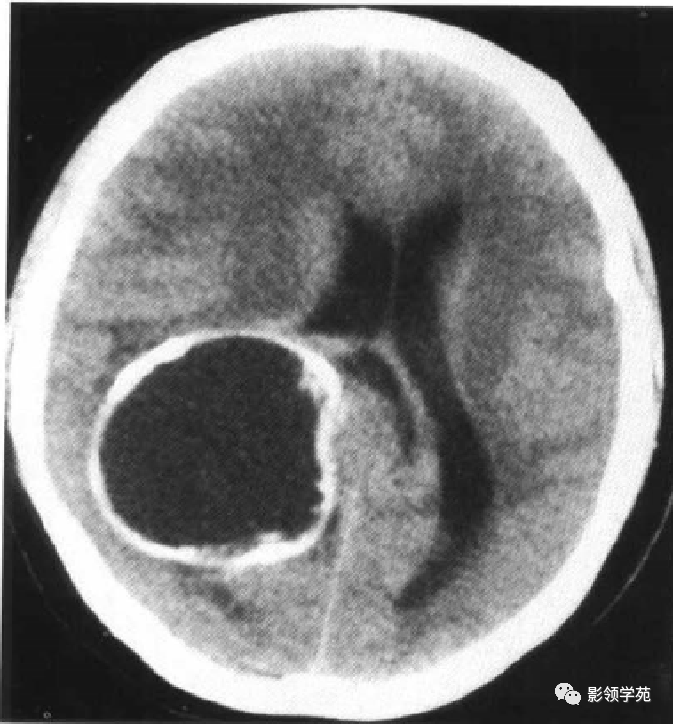内囊CT图片