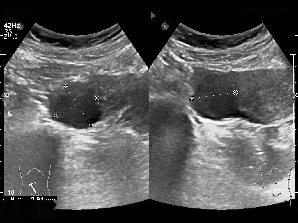 巧克力囊肿 超声图片