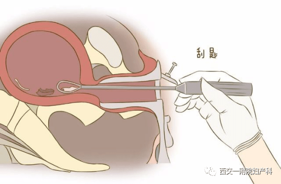 婦科手術之診刮