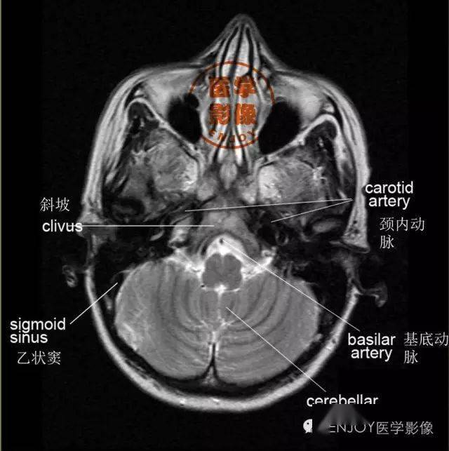 颅脑mri矢状位解剖图图片