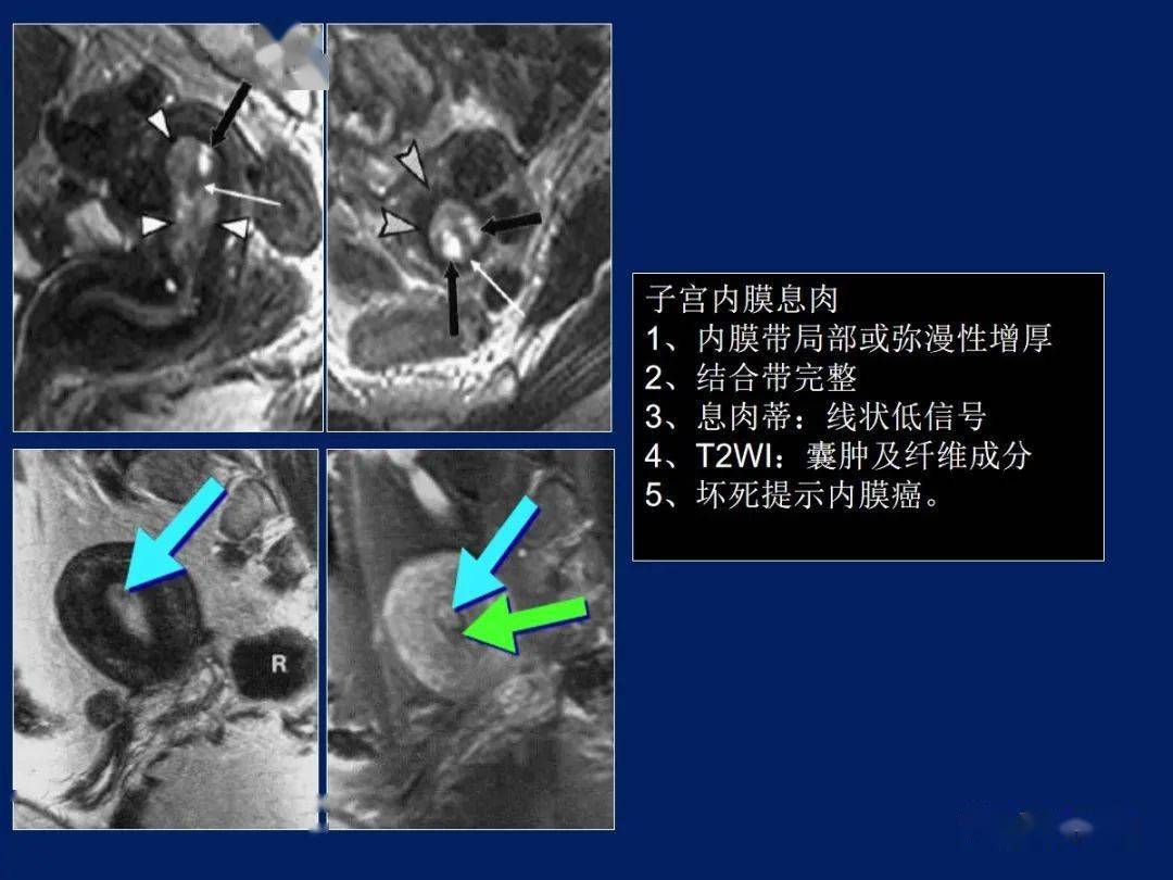 妇产科常见疾病mri表现