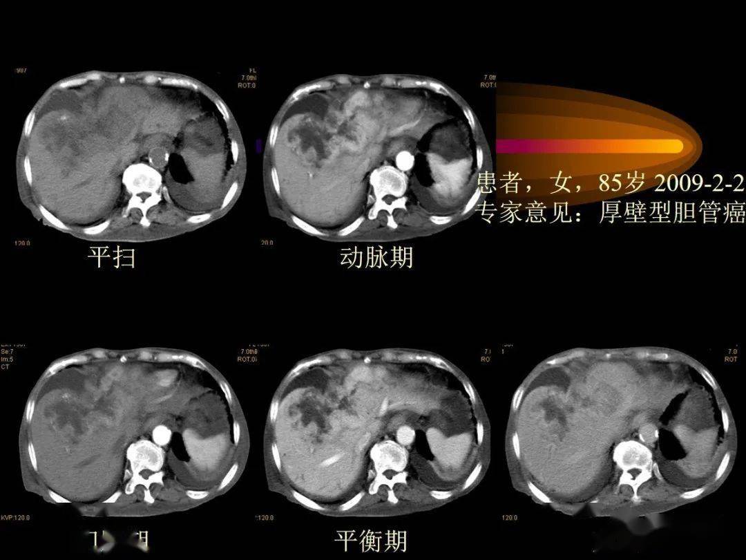 肝内周围型胆管细胞癌的影像特征
