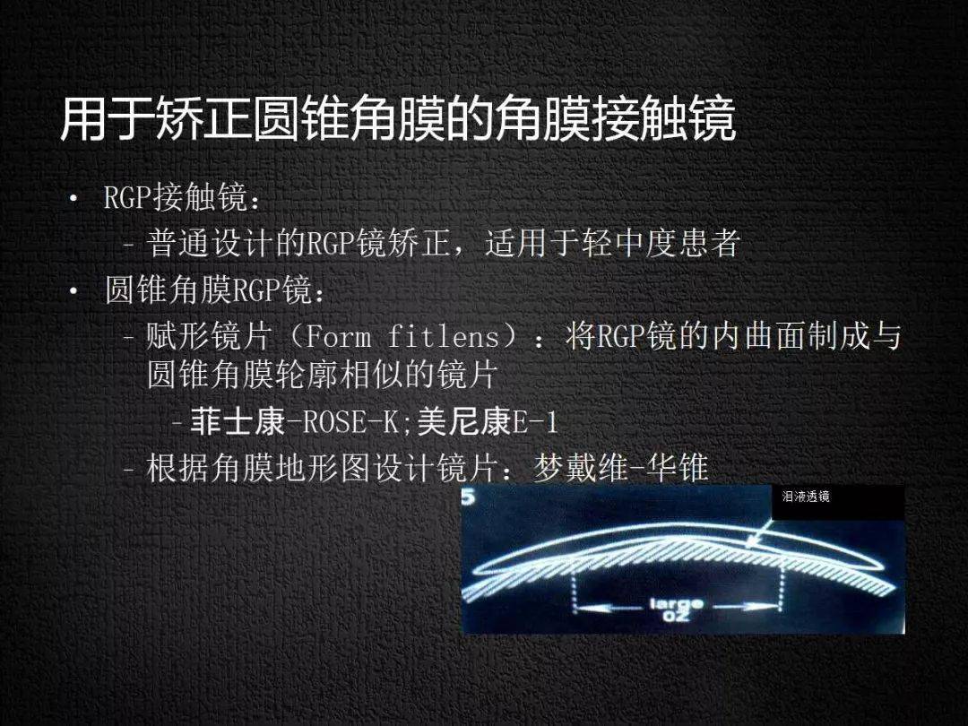 【眼视光】 RGP临床运用-搜狐大视野-搜狐新闻