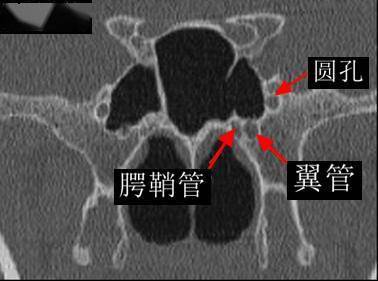 软腭CT解剖图片