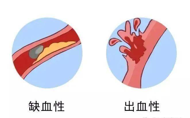 卒中中心中风可怕溶栓有效准确识别迅速治疗