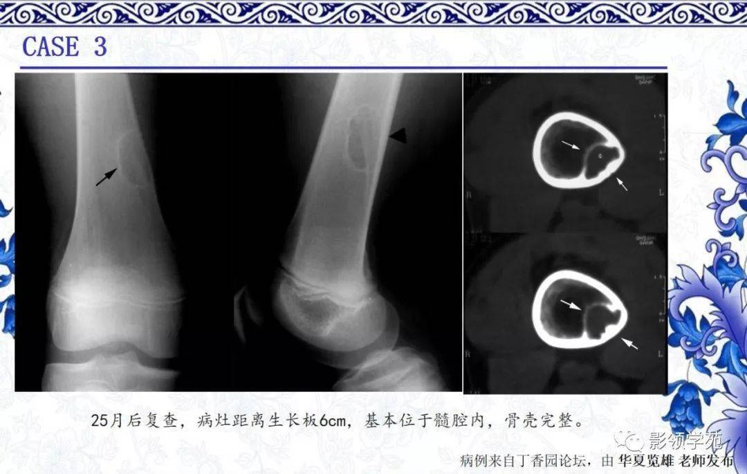 非骨化性纤维瘤CT图片图片