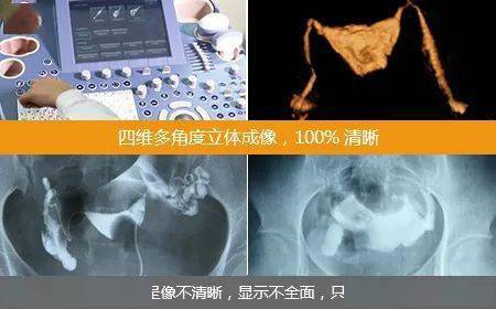 治疗不孕不育从这份输卵管造影全攻略开始