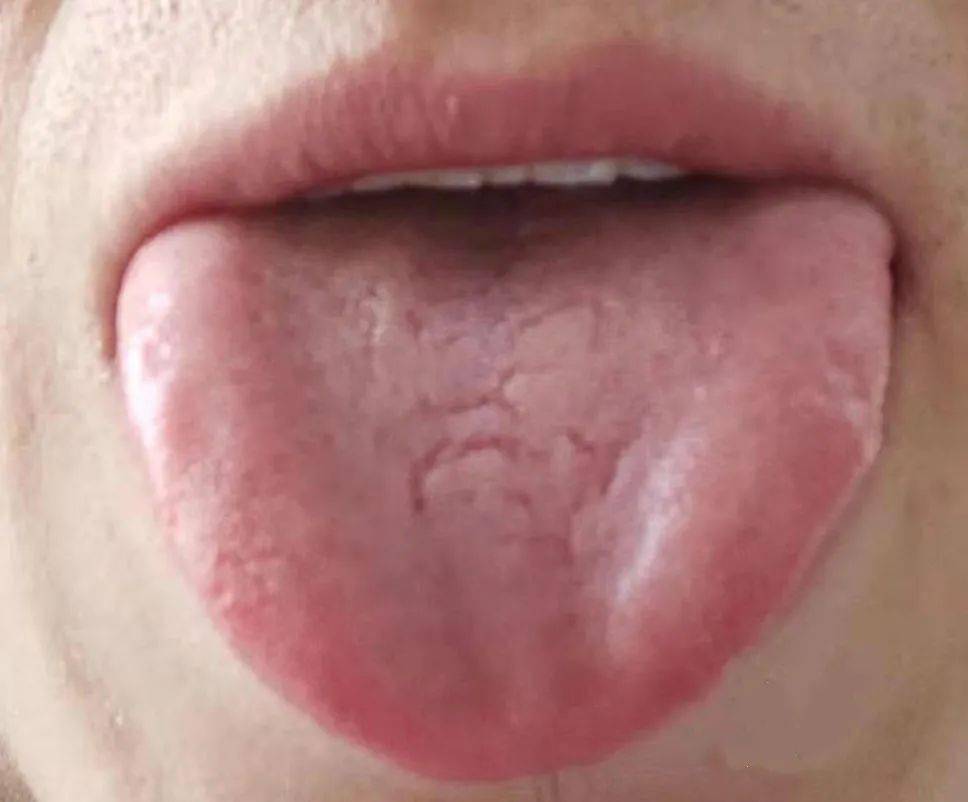 得了胃癌症舌头图片图片