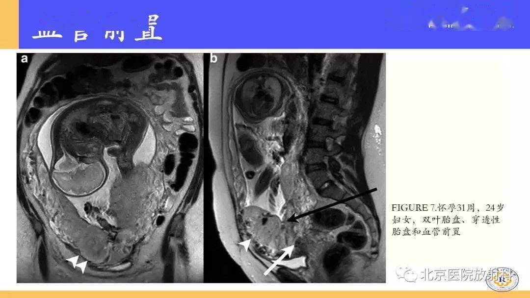 核磁共振胎盘植入图片图片