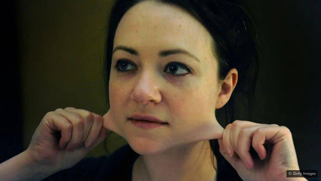 "弯"的异常学:埃勒斯-当洛斯综合征是怎么回事?_疾病