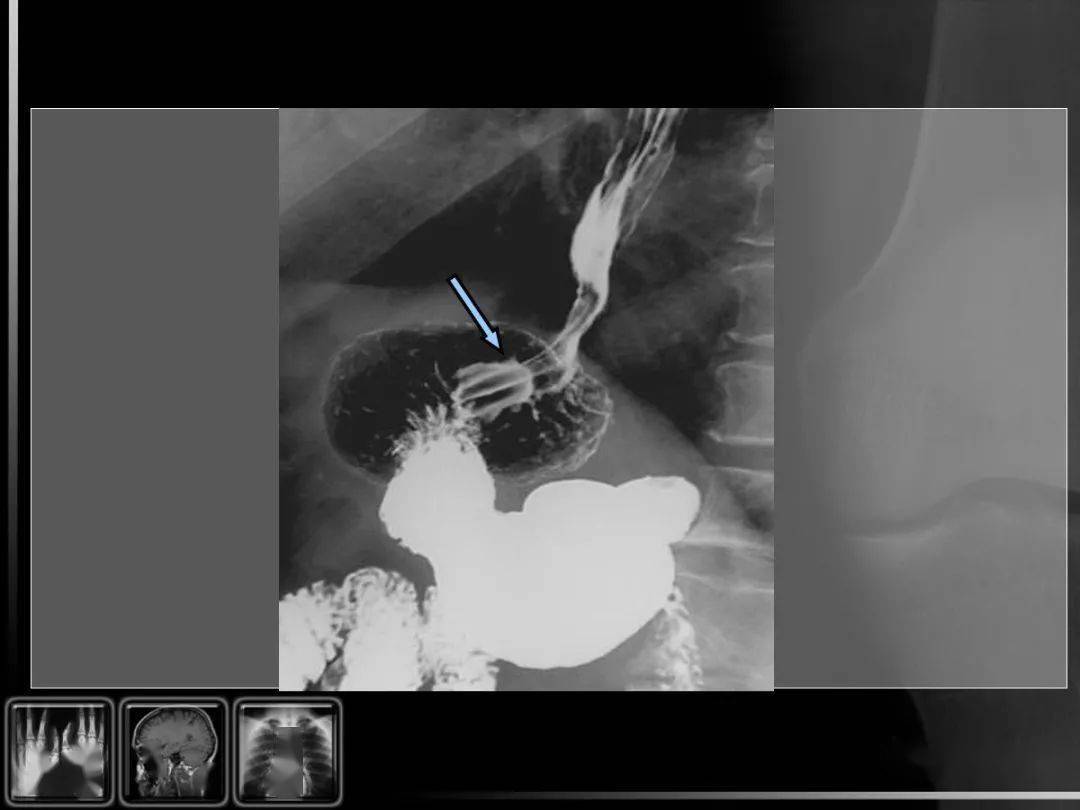 【汇总】消化道疾病影像诊断与鉴别_造影