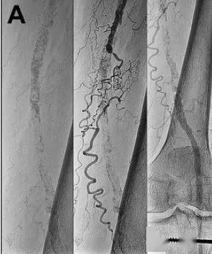 paveandcrack技术之如何更好的疏通股腘动脉长段硬化闭塞伴重度钙化