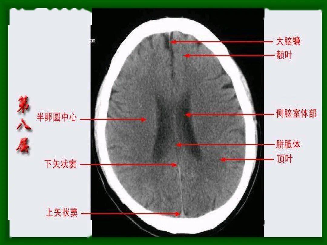 头颅ct扫描定位线图片图片