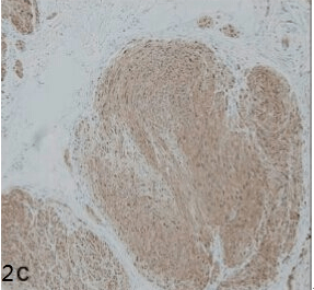 今日病例丛状神经鞘瘤伴局限性多毛症