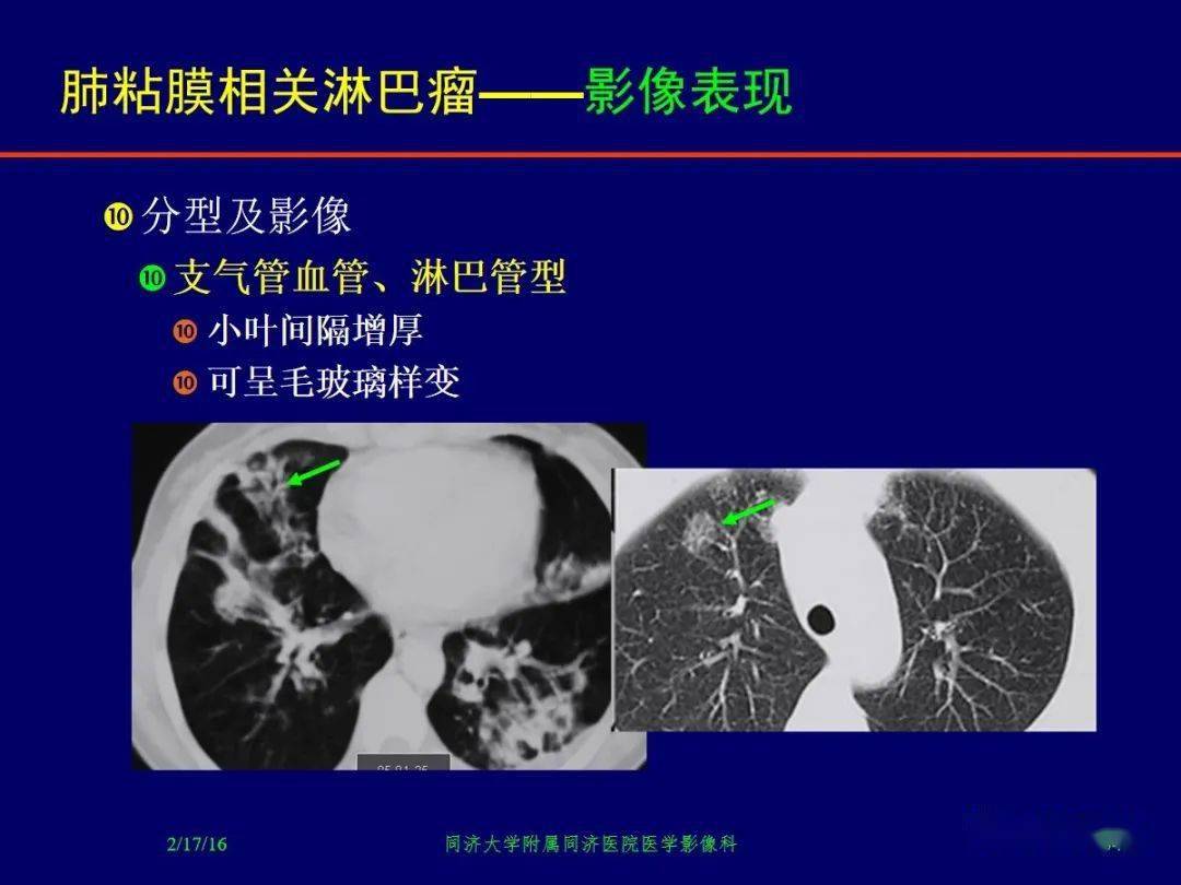 肺粘膜相关淋巴瘤影像诊断