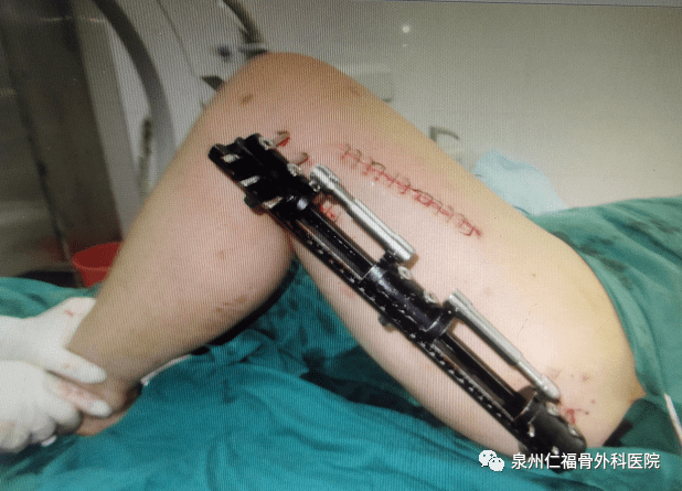 大腿骨折手术全过程图片