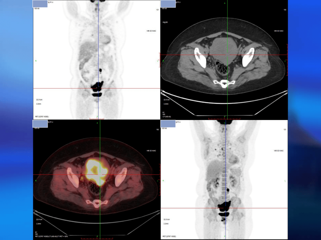 分享 高建英 pet/ct在女性生殖系统肿瘤中的价值