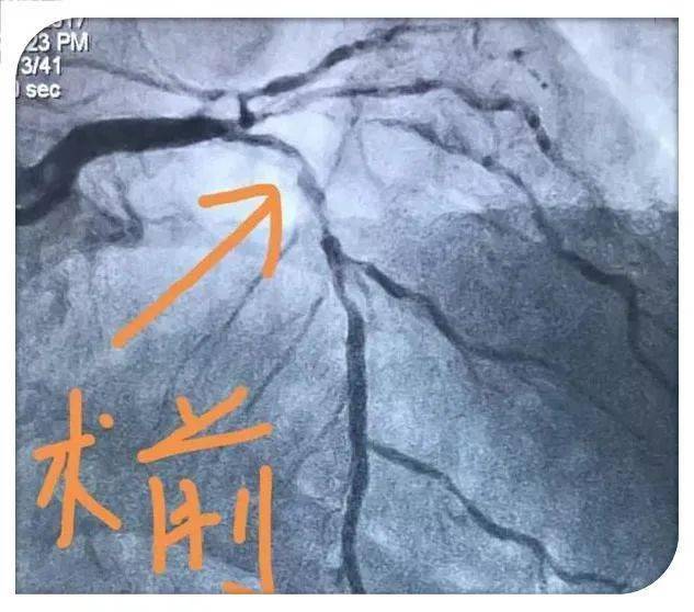 特别是对于突发心脏血管梗塞时,及