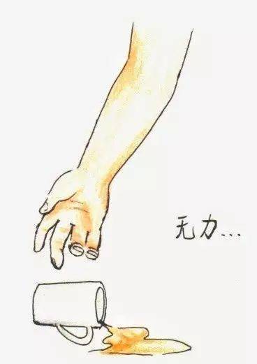 a— arm同时向前平举手臂,看是否有一侧无力s— speech观察是否出现