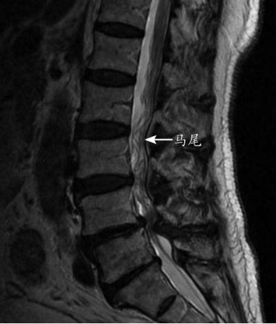 mri提示腰椎管狭窄症的几个特殊征象你肯定忽视过