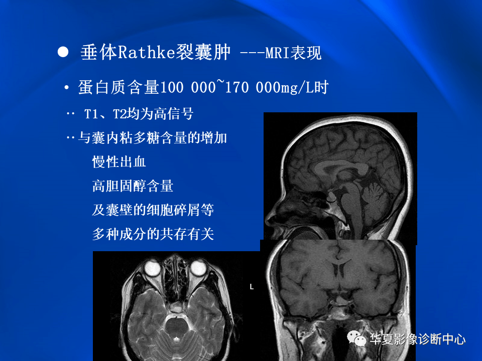 垂体rathke裂囊肿mr表现